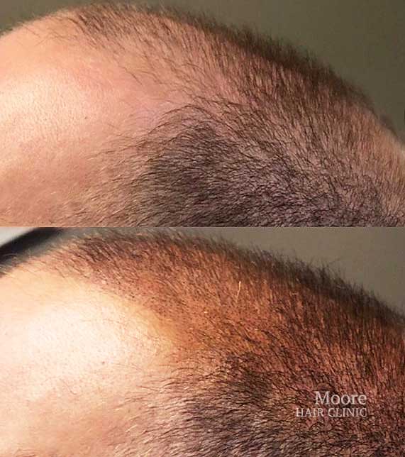 smp scalp micropigmentation for hair loss st louis missouri
