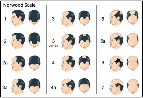 male pattern baldness treatment st louis missouri