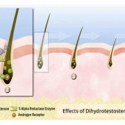 effects of dht hair loss cause