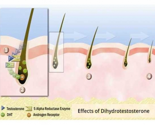 effects of dht hair loss cause