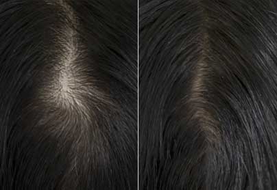 female hair loss treatment st louis mo