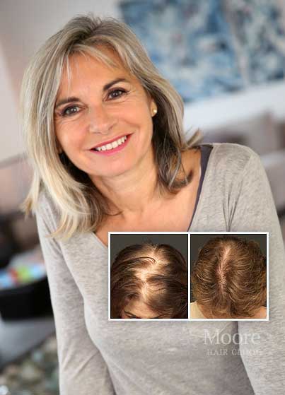 female hair transplants womens FUE hair restoration St. Louis MO