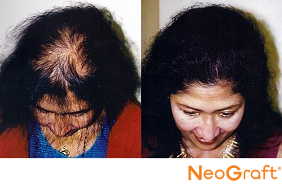 NeoGraft FUE Hair Transplant Women St Louis Missouri