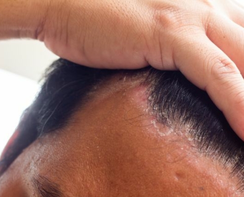 scalp disease hair loss treatment st louis