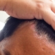 scalp disease hair loss treatment st louis